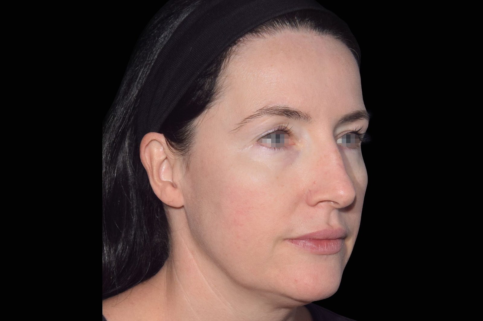 emface-before-after-1-scaled.jpg