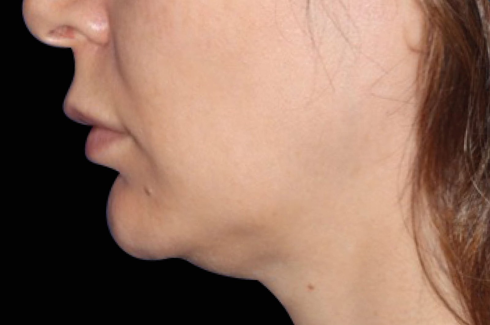 emface-before-after-10-scaled.jpg