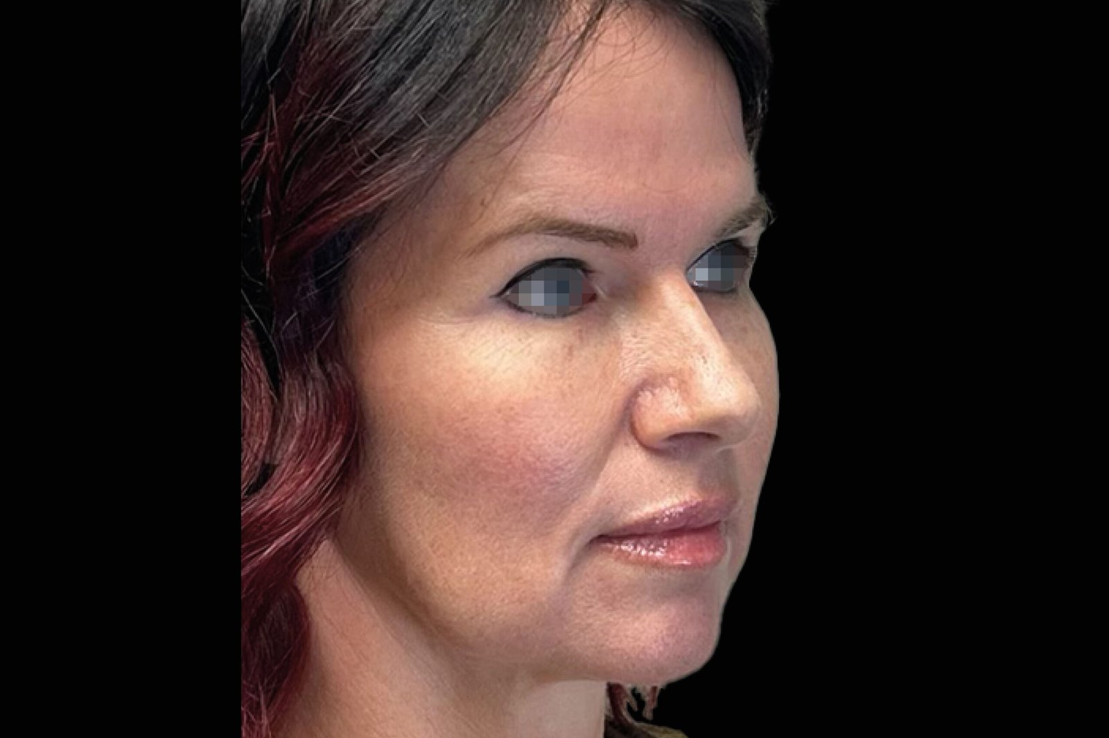 emface-before-after-11-scaled.jpg