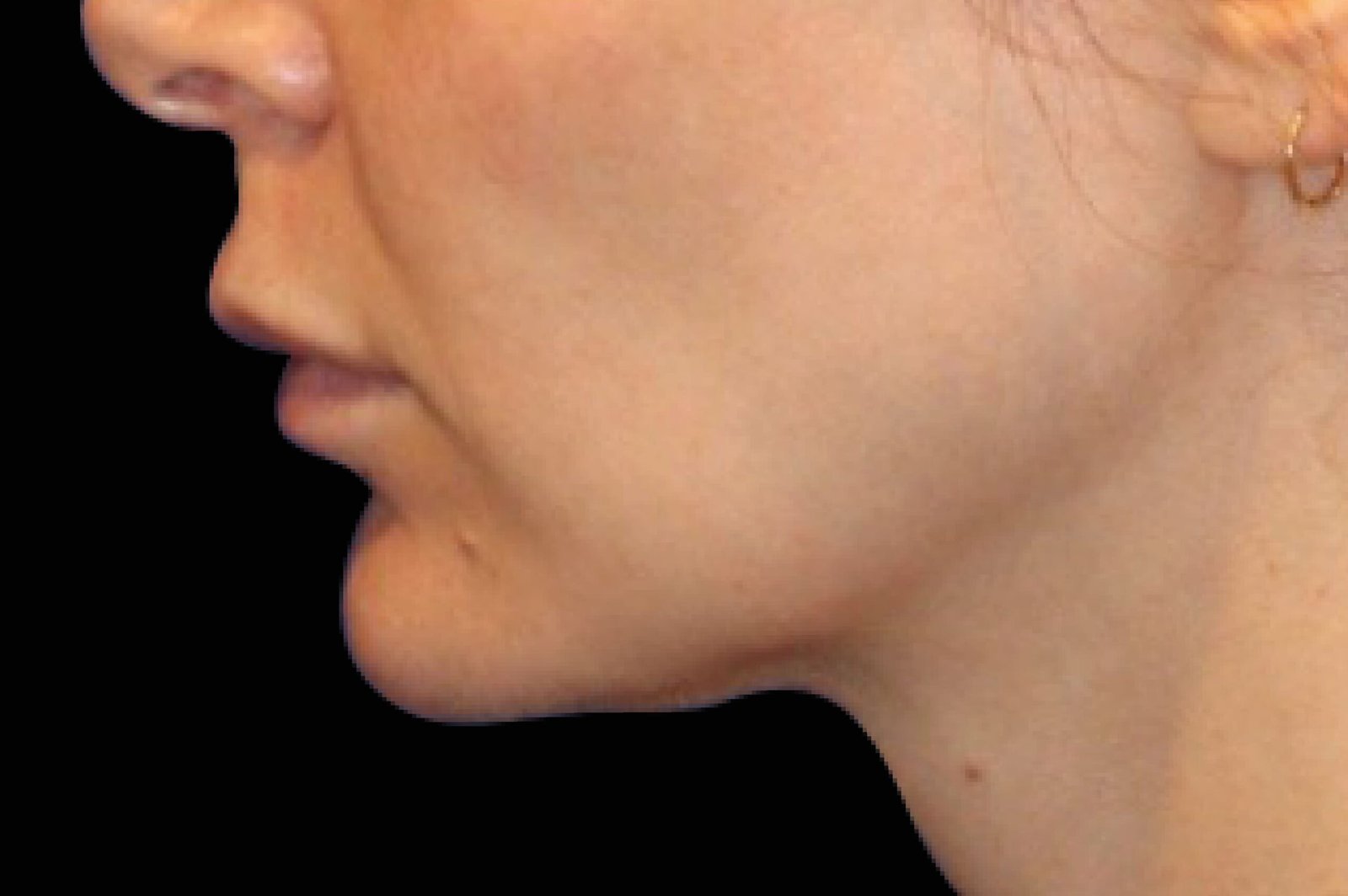 emface-before-after-12-scaled.jpg