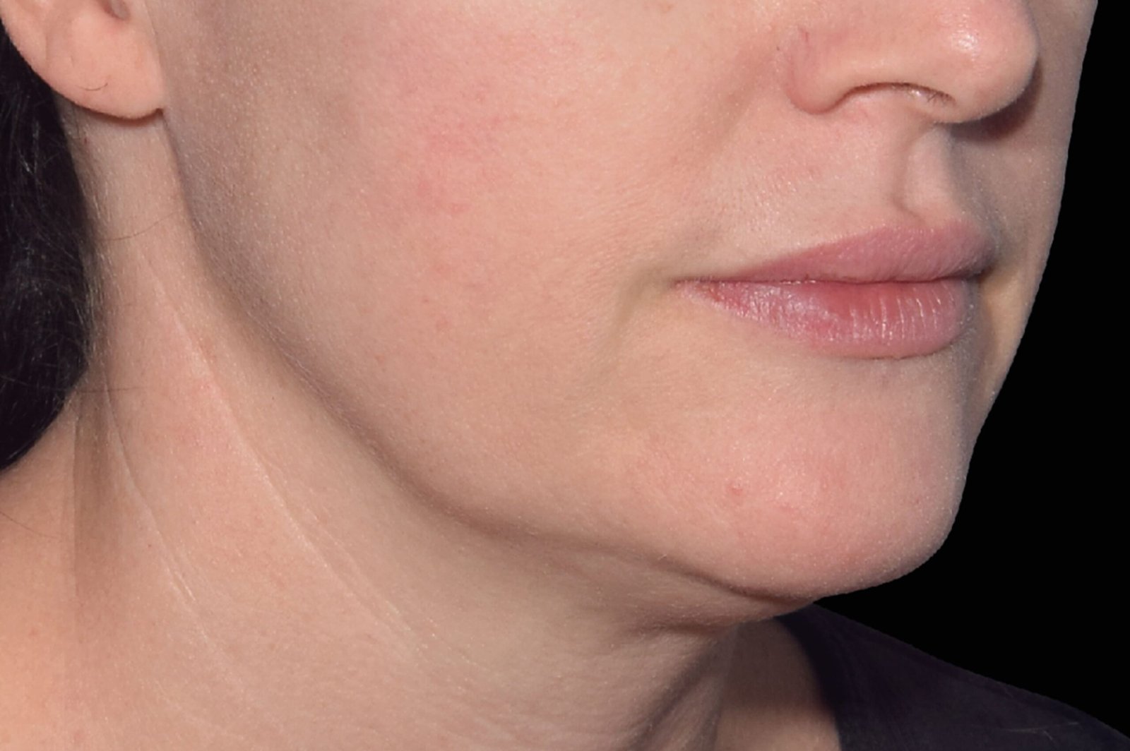 emface-before-after-2-scaled.jpg