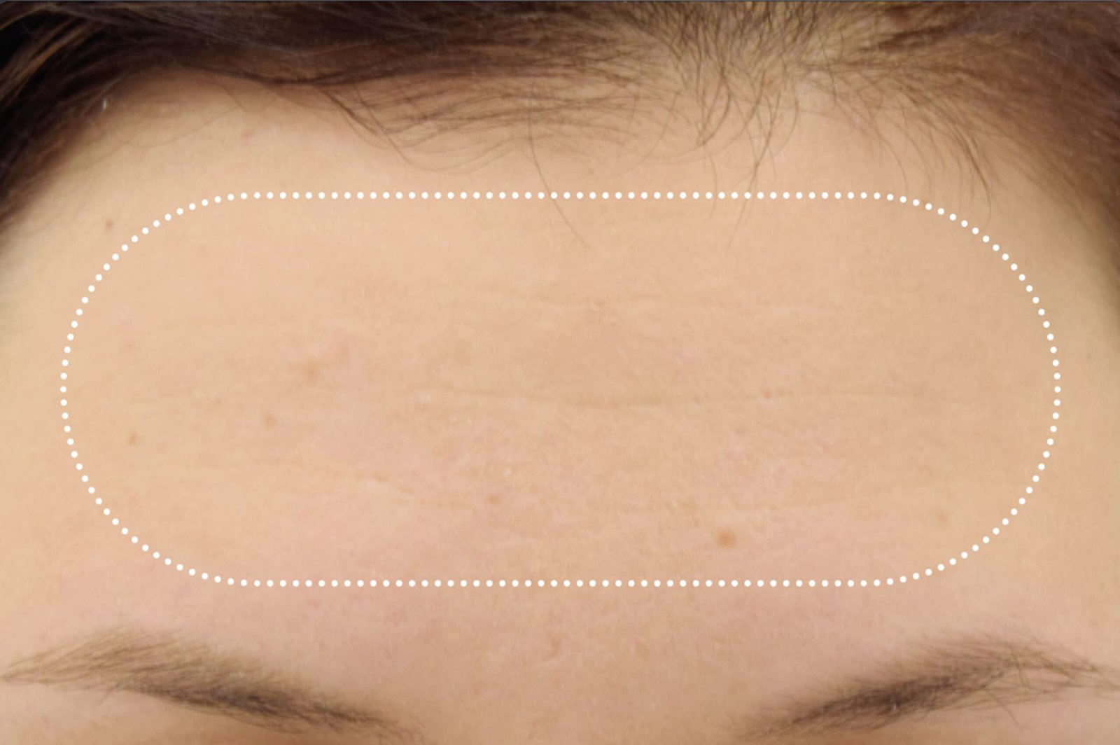 emface-before-after-3-scaled.jpg