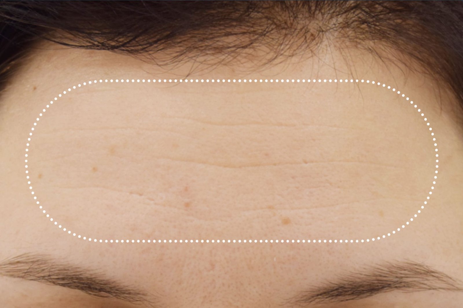 emface-before-after-5-scaled.jpg