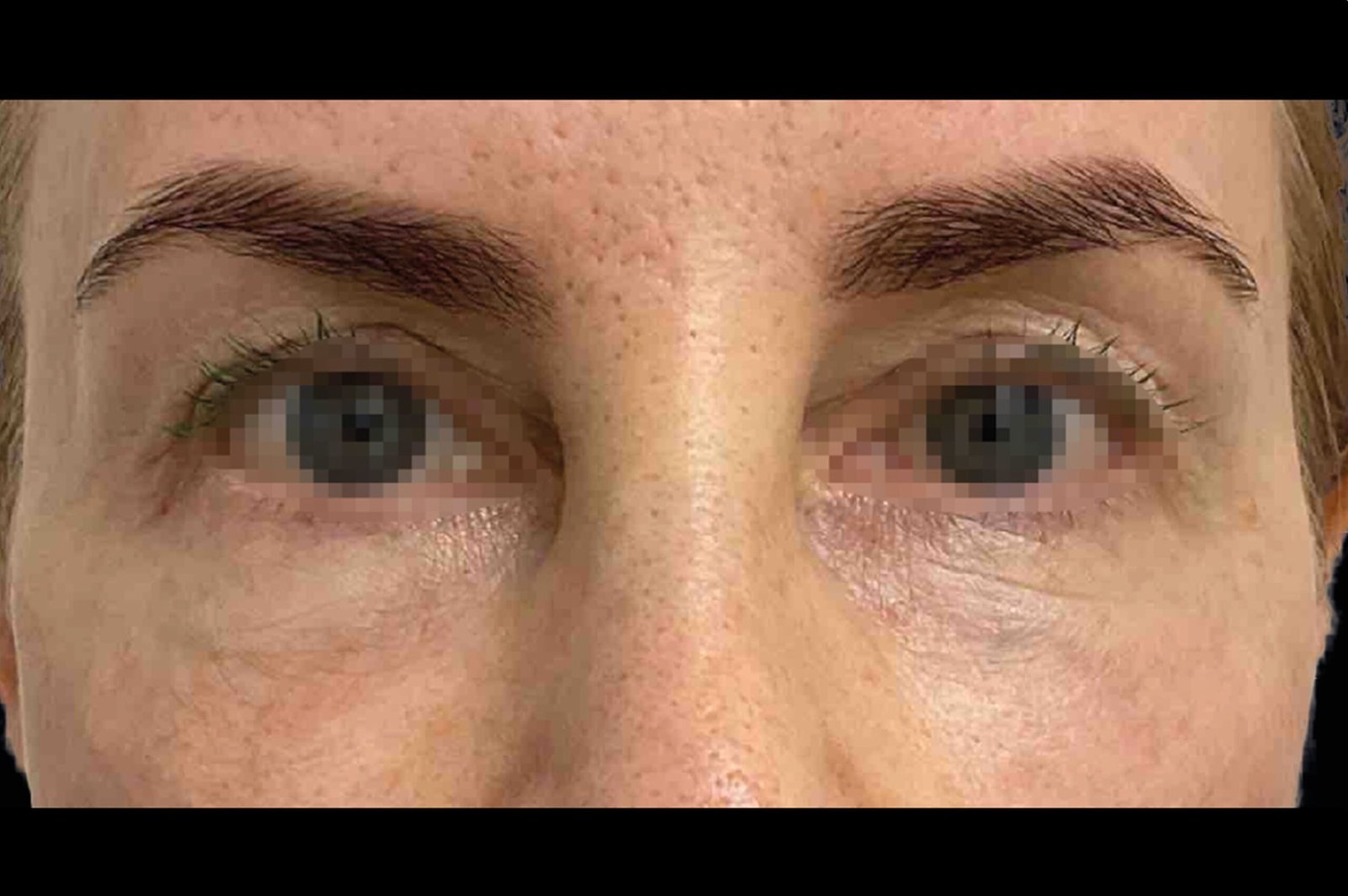 emface-before-after-7-scaled.jpg