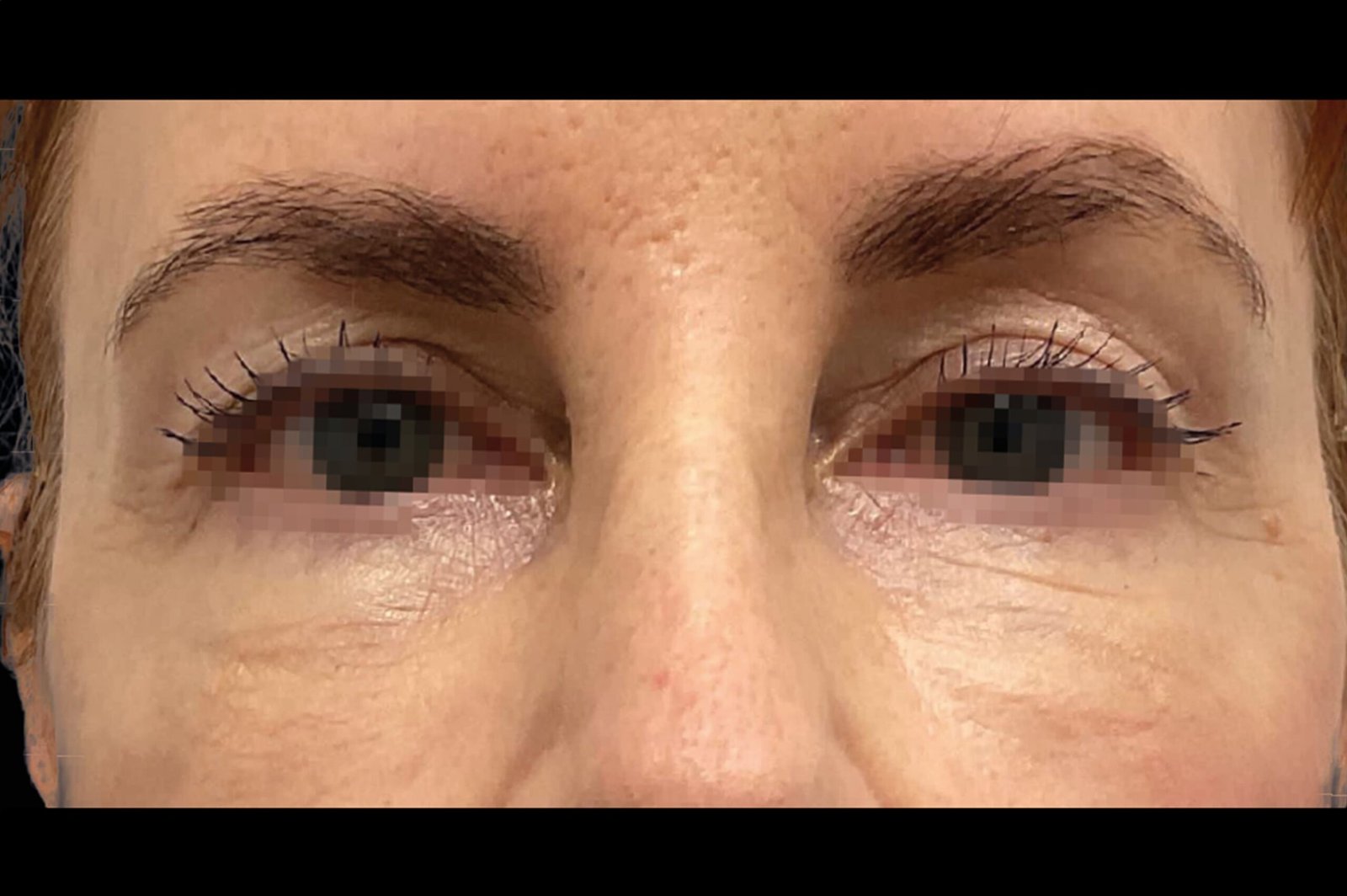 emface-before-after-8-scaled.jpg