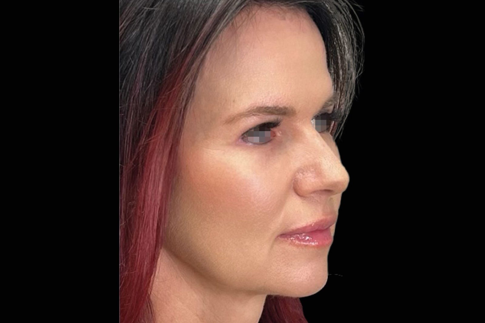 emface-before-after-9-scaled.jpg