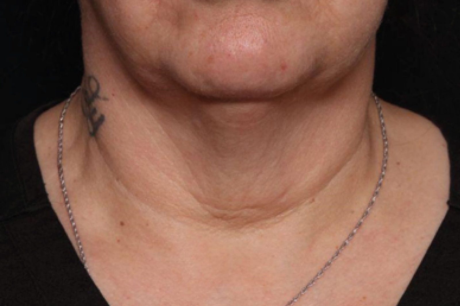 exion-before-and-after-2-scaled.jpg exion-before-and-after-2-scaled.jpg