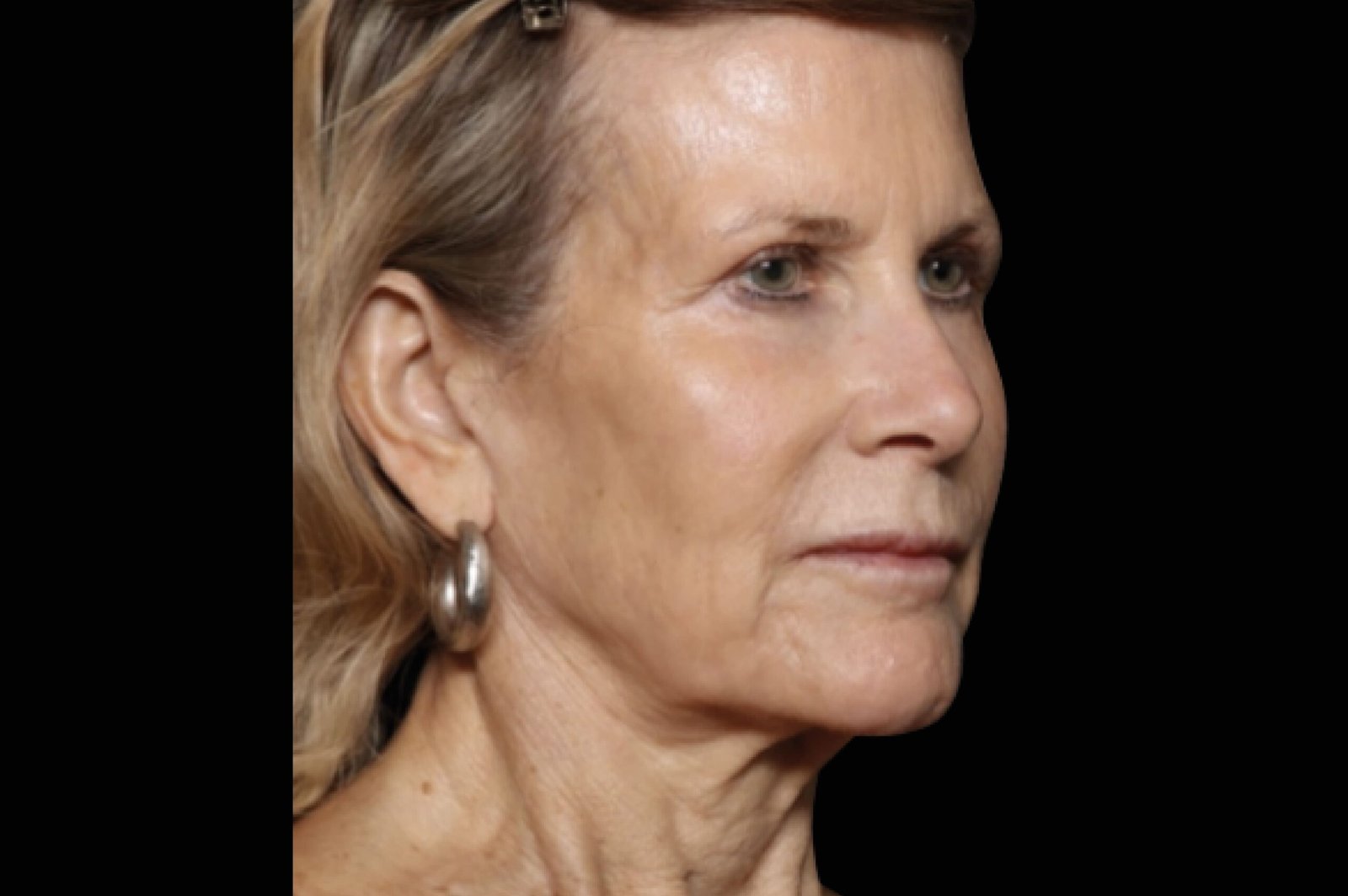 exion-before-and-after-5-scaled.jpg exion-before-and-after-5-scaled.jpg