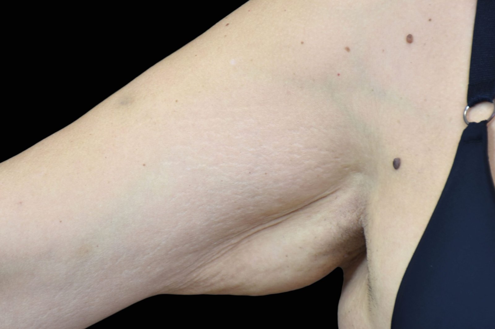 emtone-before-after-1-scaled.jpg
