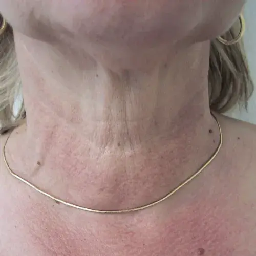 poly_Neck_After