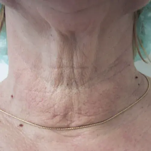 poly_Neck_Before